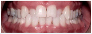invisalign: before and after - cross bite - before